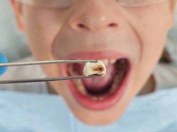 Best Emergency Dental Care for Broken or Chipped Teeth in South Monrovia Island, CA